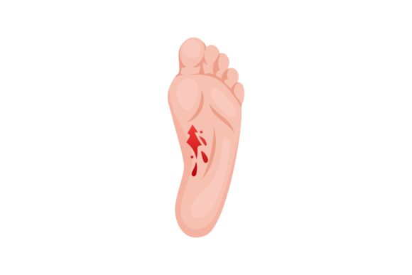 Download Open Laceration on Heel, Lower Part of F - Premium Resources
